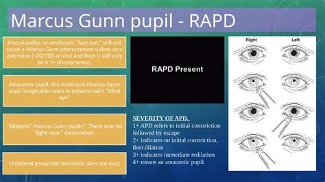 Trastornos de la pupila - Disorders of pupil | PPTX
