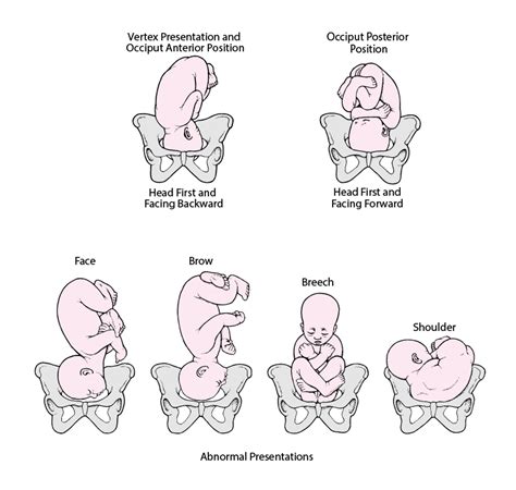 Fetal Presentation, Position, and Lie (Including Breech Presentation ...