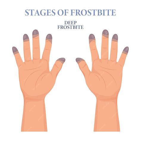 Frozen hands in different stages. medical frostbite. stages of ...
