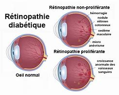 Image result for retinopathies
