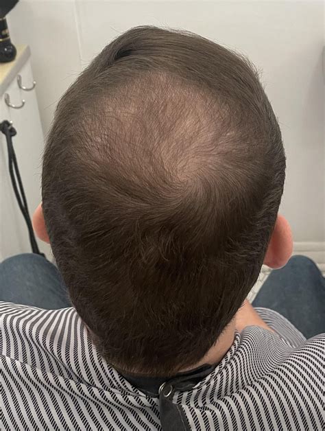 Can women take finasteride? : r/HairlossResearch