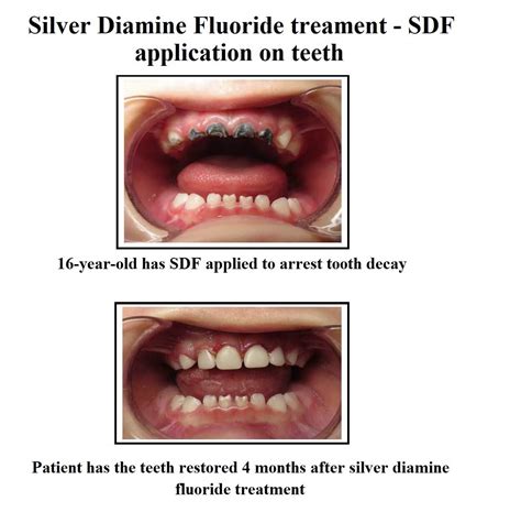 Does Silver Diamine Fluoride permanently stain teeth? | News | Dentagama