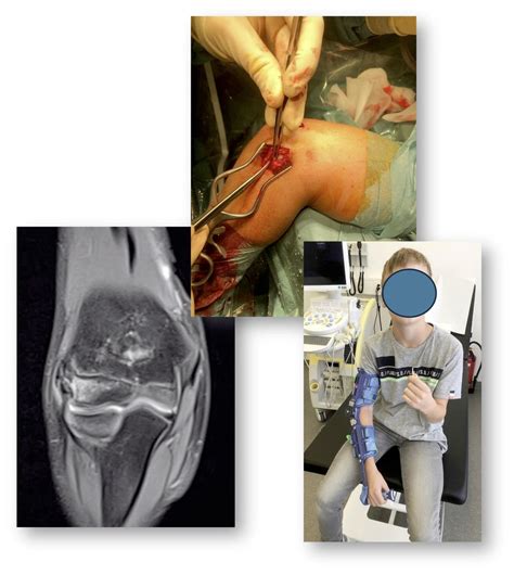Instabilität der Schulter und des Ellbogens im Wachstumsalter ...