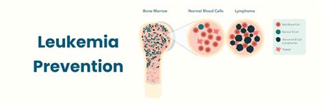 Estilo de vida y consejos para la prevención de la leucemia en Vizag