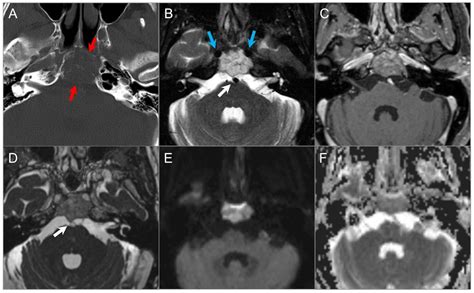 Imaging of Skull Base Tumors