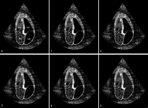 Echocardiographic detection of transpulmonary bubble transit during ...