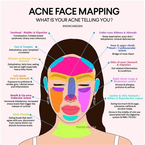 The acne face map clear skin through acne face mapping – Artofit