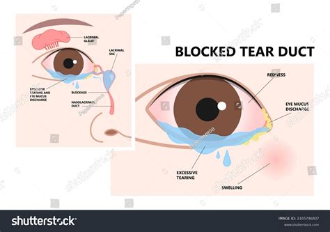 Swollen Lacrimal Gland