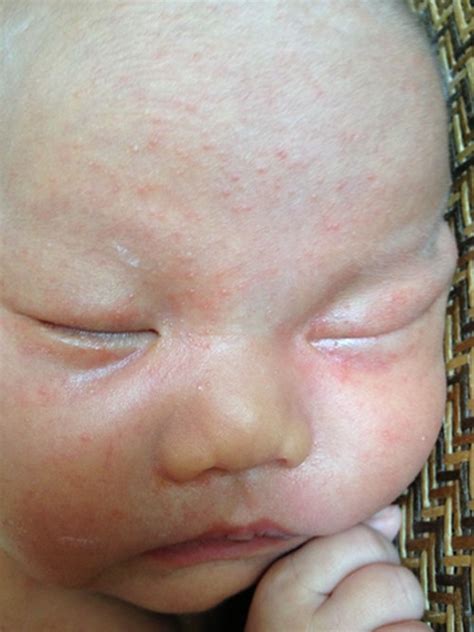 1个月婴儿湿疹图片,一个半月宝宝湿疹图片,婴儿轻度湿疹图片_大山谷图库