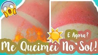 10 maneiras de aliviar a dor das queimaduras provocadas pelo sol ...