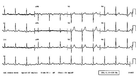 Normal ECG Read Out 的图像结果