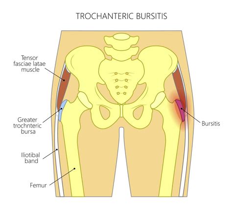 9 Hip Bursitis Exercises To Build Strength & Relieve Pain