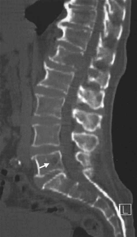 Multidetector CT of the Spine in Multiple Myeloma: Comparison with MR Imaging and Radiography | AJR
