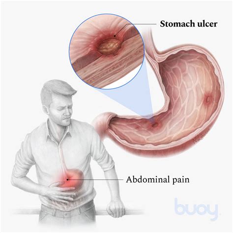 What Is The Number 1 Cause Of Stomach Ulcers - Infoupdate.org