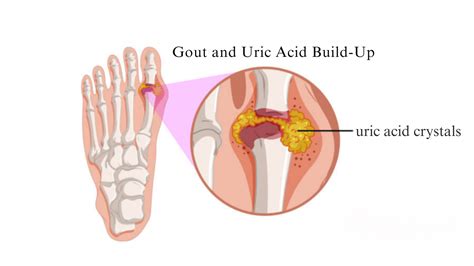 What Causes Uric Acid Build Up