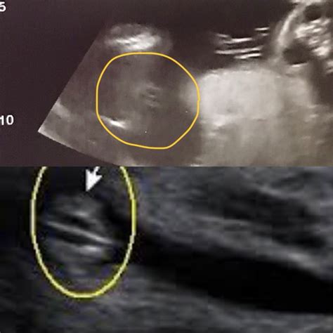 Hamburger Sign Ultrasound