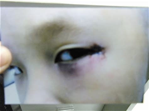 8岁男孩上课时眼部受伤缝了三针(图)-搜狐滚动