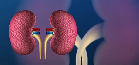 Kidney Stone Specialist In Varanasi, Uttar Pradesh | Nephrology ...