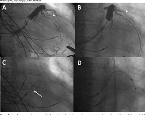 Image result for Synchronized Cardioversion Lead Placement