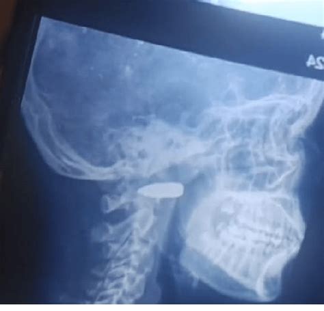 Chhattisgarh: 4 Children Injured, Girl Received Serious Bullet Injury ...