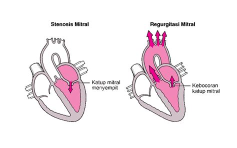 Gambaran Umum tentang Gangguan Katup Jantung - Gangguan Jantung dan Pembuluh Darah - Manual MSD ...