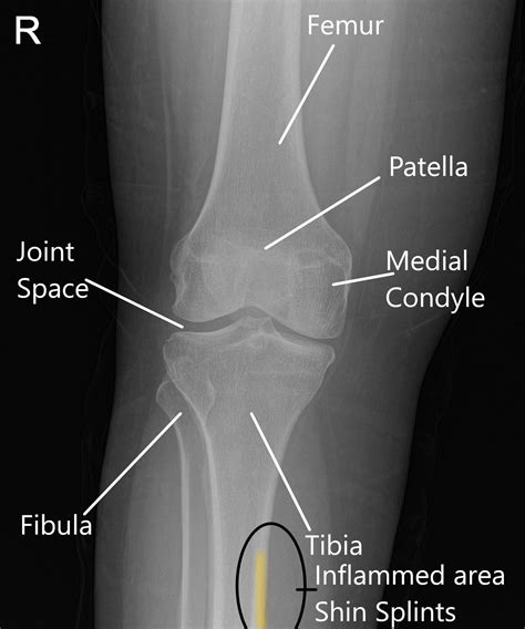 Are Shin Splints Visible On X Ray at Lachlan Legge blog