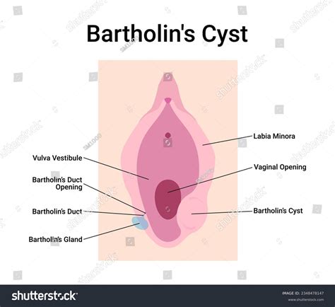 Bartholin Gland Duct