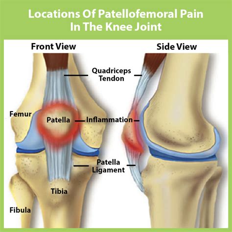 Pain Under Kneecap