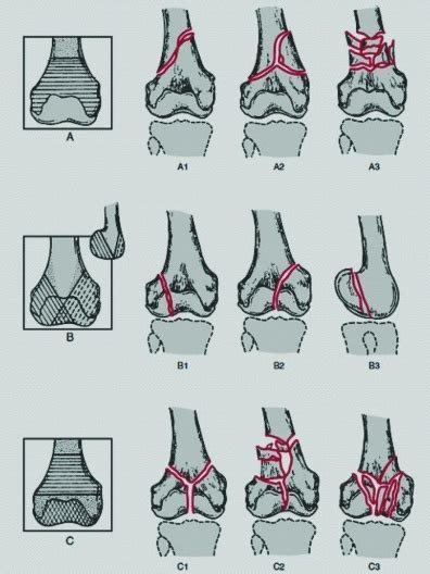 Comparative study of functional outcome in single plating and dual ...