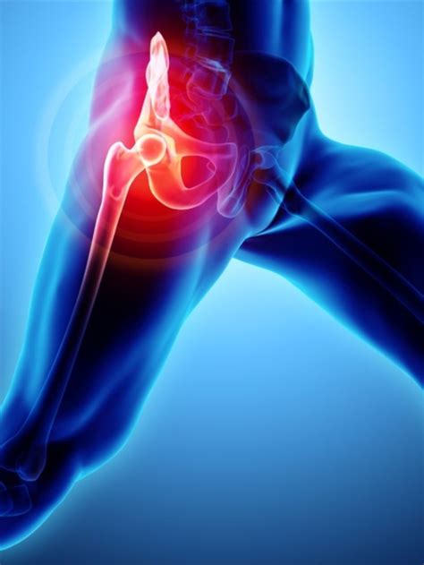 Top Causes of Hip Joint Damage and When to Seek Help - ORTHOPOD
