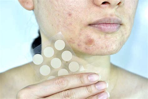 All you need to know about pimple patches | Femina.in
