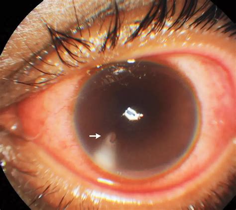 Mangalore doctors report rare case of Corneal Bee Sting in NEJM