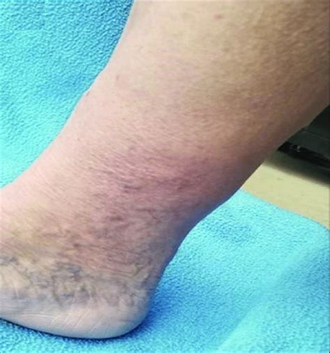 https://www.researchgate.net/profile/Thomas-Wright-33/publication/361096493/figure/fig1/AS%3A1183599768403968%401659203583937/Close-up-of-left-lateral-ankle-and-lower-leg-of-Case-3-Notice-the-slight-erythema.png