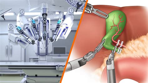 Acronym For Xi Robotic Assisted Cholecystectomy
