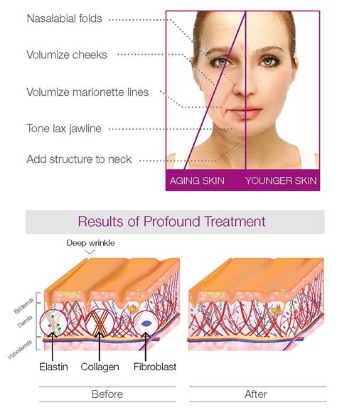 Image result for Profound Face Procedure