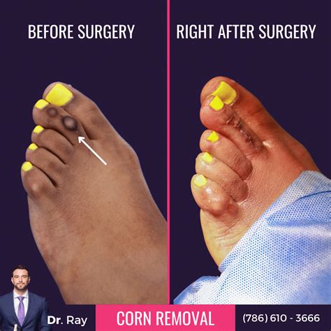 What to Know About Corn Removal Surgery Before And After