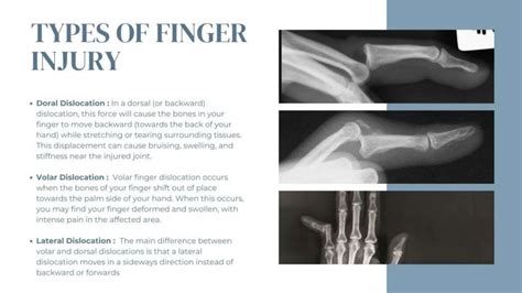 Image result for Finger Dislocation Treatment