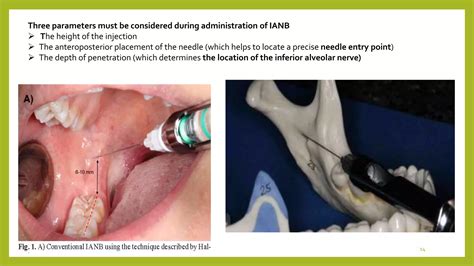 Inferior alveolar nerve | PPTX
