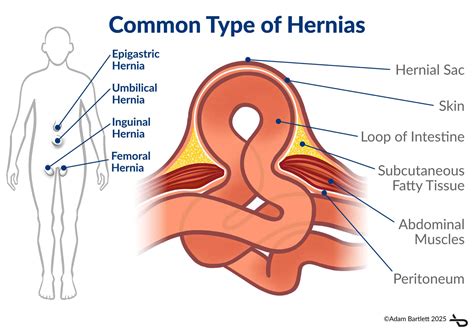Hernias Types Symptoms And When To Seek Urgent Care Inguinal Hernia: