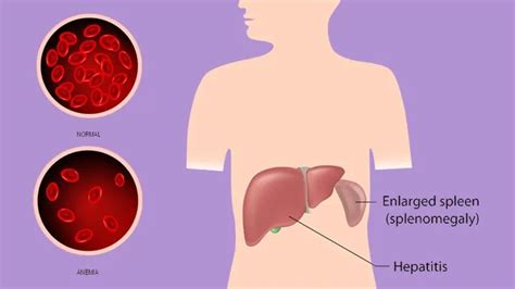 Symptoms of Mononucleosis