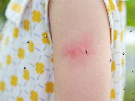 Mosquito Bites Pictures