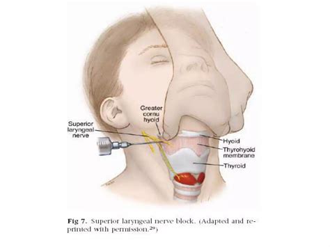 Image result for Awake Intubation