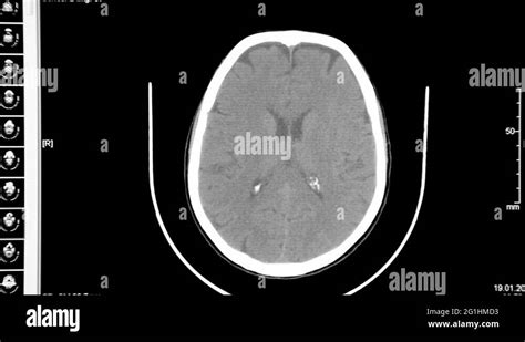 Image result for SPECT Scan Brain Prefrontal Cortex