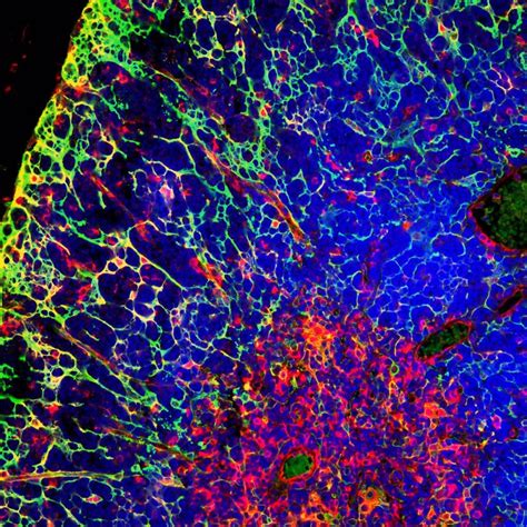 Un nuevo ensayo cambia la práctica clínica en leucemia linfoblástica aguda al mantener a los ...