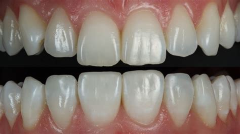 Pros And Cons Of Composite Bonding | Smile Stories
