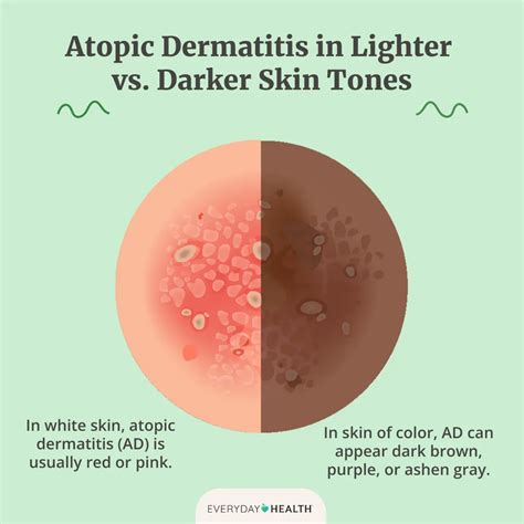 What Is Atopic Dermatitis? Symptoms, Causes, Diagnosis, Treatment, and ...
