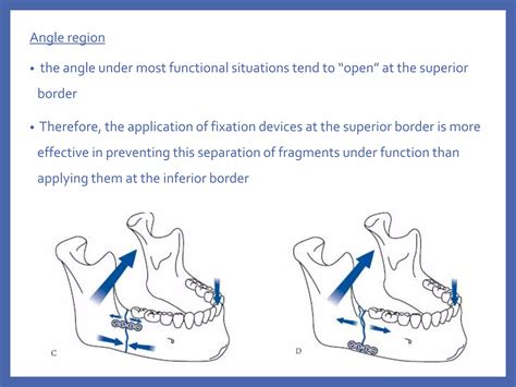 fixation systems in maxillofacial fractures | PPTX