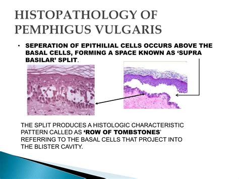 Pemphigus and Pemphigoid | PPTX
