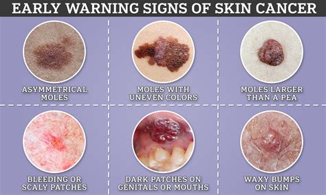 Skin Cancer Symptoms Pictures And Signs – GKAAJE