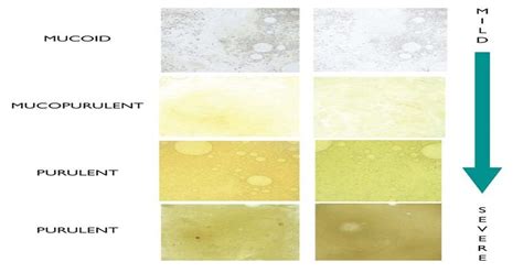 what does the color of phlegm mean ohio state medical center - what ...